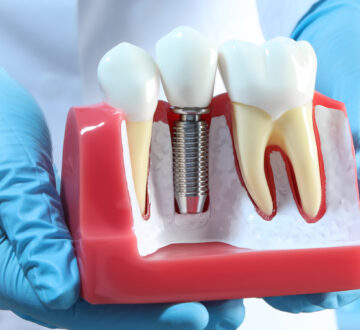 What Foods to Eat & Avoid After Getting Dental Implants?