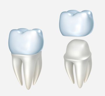 How Dental Crowns Fit into a Full Smile Makeover