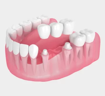 Tips for Caring for a Dental Bridge