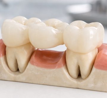 Can a Dental Bridge Improve Your Smile and Bite?
